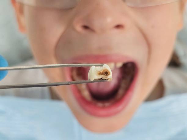 Best Emergency Tooth Extraction in Maysville, MO